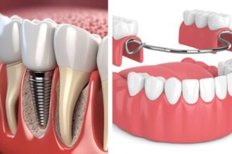 Dental Implants Vs. Dentures: What Should Patients In The Woodlands, TX Consider?